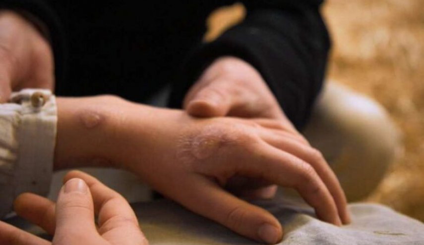 الصحة العالمية: تسجيل 131 حالة لجدري القردة في 17 دولة

