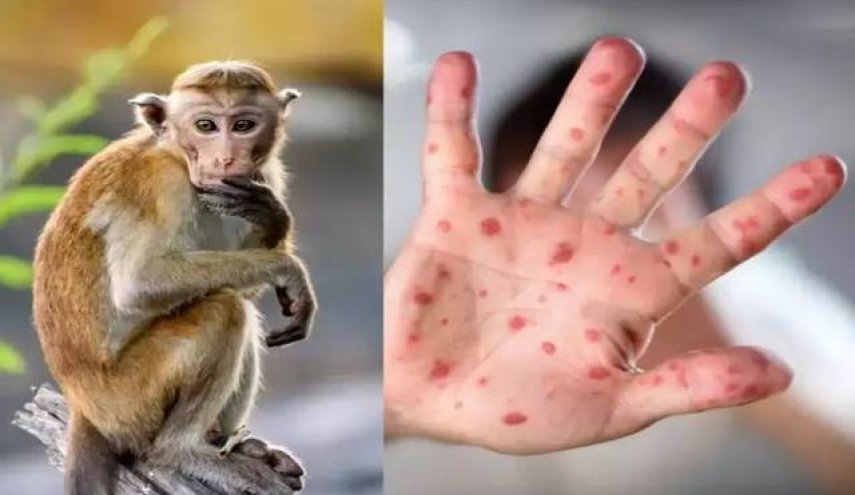 مصر تسجل أول حالة إصابة بجدري القرود