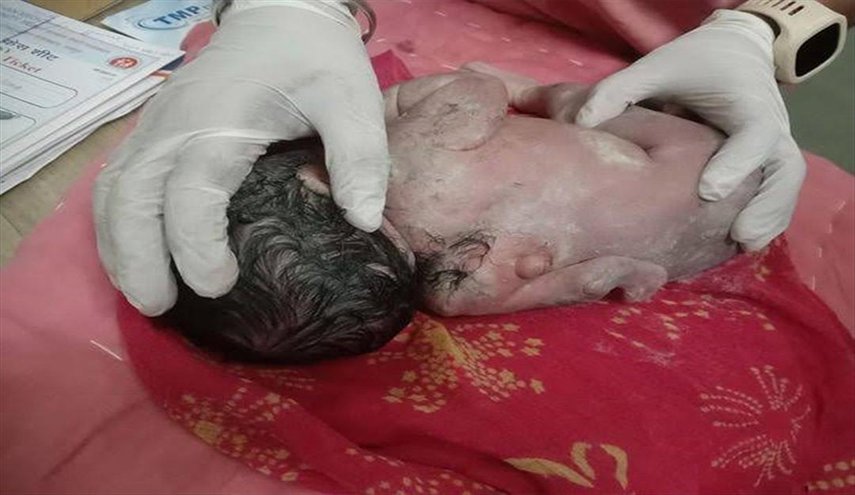  ظاهرة طبية نادرة للغاية في الهند.. طفل رضيع بهذه المواصفات!