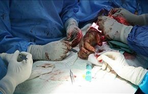 ايران..اجراء اول عملية لزرع يد انسان من الطعم المغاير