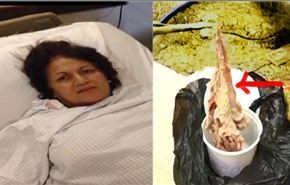 بالفيديو/ منشفة اخرجت من بطن مريضة بعد 8 سنوات!