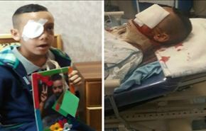 طفل فلسطيني خرج لشراء الفلفل ففقد عينه برصاص الاحتلال