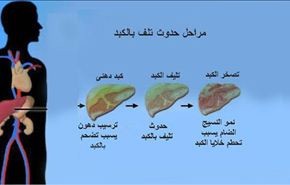 لو عندك كبد دهني.. الصيام فرصة ذهبية للعلاج بإنقاص الوزن