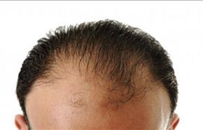 بشرى... اكتشاف دواء لمحاربة الصلع في 10 أيام