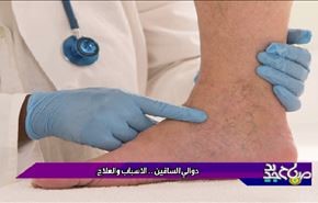 دوالي الساقين الاسباب والعلاج
