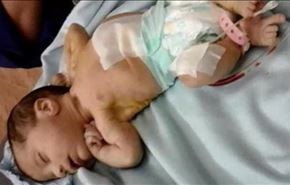 هل تصدق...جنين بشعر وأسنان في بطن رضيعة عمرها 13 يوماً!