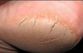 علاج سريع وبسيط لتشققات كعب القدمين