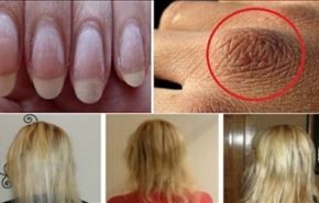 لعلاج تساقط الشعر وجفاف الجلد والاظافر، عليك بـ...