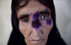 بیماری مرگبار داعش منطقه را تهدید می کند