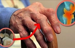 قبل تجربة العلاج لم تكن قادرة على الحركة بسبب آلام مفاصلها!