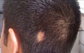 إليكم هذه الطرق لمعالجة 