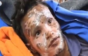 ویدیو: آثار سلاح‌های ممنوع عربستان بر پیکر یمنی‌ها