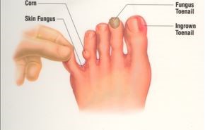 فطريات الأظافر .. أهم طرق الوقاية والعلاج