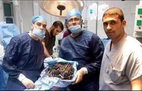 اشیاء عجیب در معدۀ زن مصری +عکس