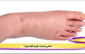 ما هي أسباب تورم القدمين؟