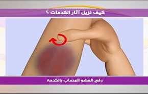 كيف نزيل آثار الكدمات ؟