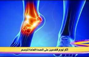 آثار تورم القدمين على الصحة العامة للجسم