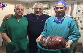 بالصور... استئصال ورم يزن 43 كيلو من بطن سيدة