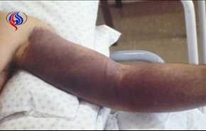 همه‌چیز درباره «تب کریمه کنگو»