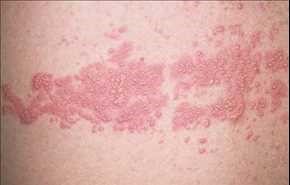 الحزام الناري خطر عليكم وعلى الآخرين.. وهذه التفاصيل!