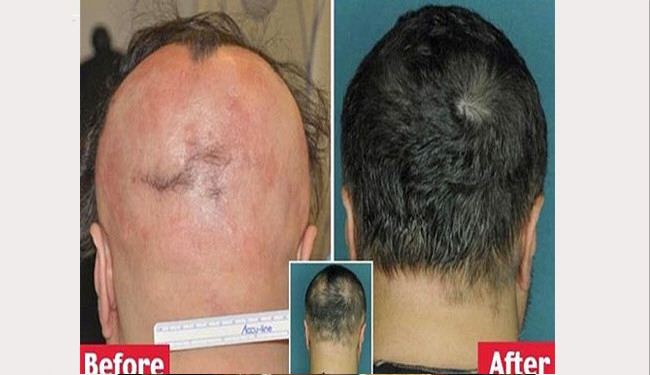 حبة صغيرة تقضي على الصلع في 5 أشهر فقط!