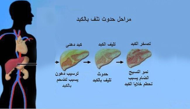 لو عندك كبد دهني.. الصيام فرصة ذهبية للعلاج بإنقاص الوزن