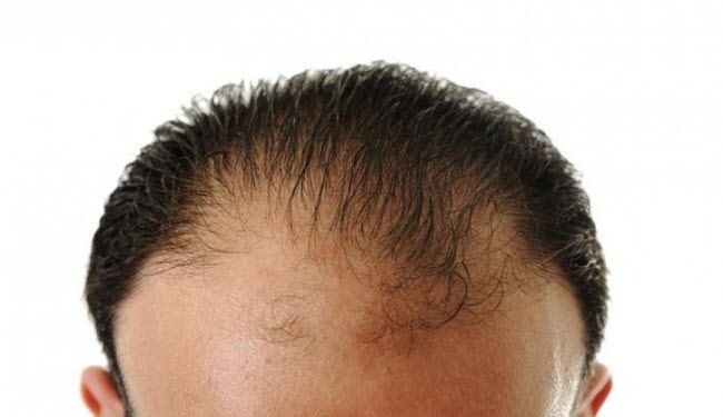 بشرى... اكتشاف دواء لمحاربة الصلع في 10 أيام