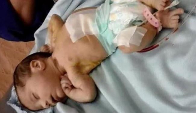 هل تصدق...جنين بشعر وأسنان في بطن رضيعة عمرها 13 يوماً!
