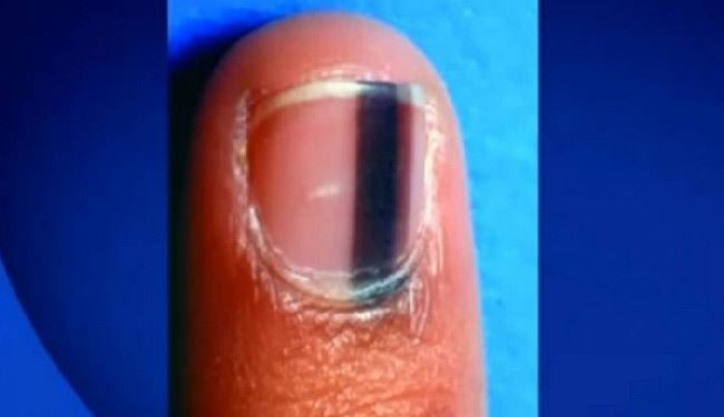 للمصاب بالنقطة سوداء على الظفر سارع إلى المستشفى!