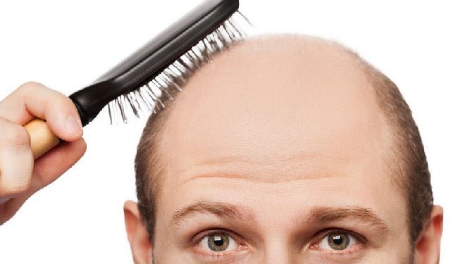 هام للرجال: لا صلع بعد اليوم مع هذه 