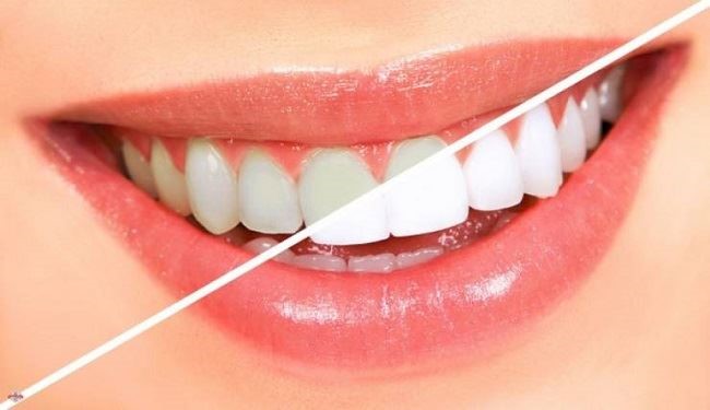 وصفة بسيطة لحماية أسنانك من الاصفرار.. تعرفي عليها؟
