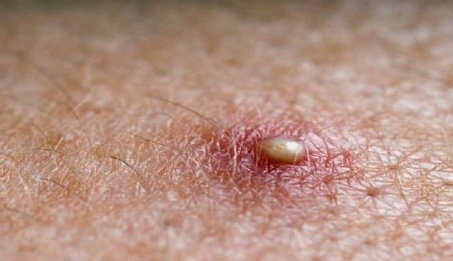 لعلاج الدمامل بكل أشكالها اليك 10 وصفات منزلية