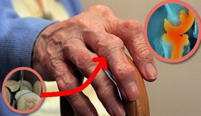 قبل تجربة العلاج لم تكن قادرة على الحركة بسبب آلام مفاصلها!