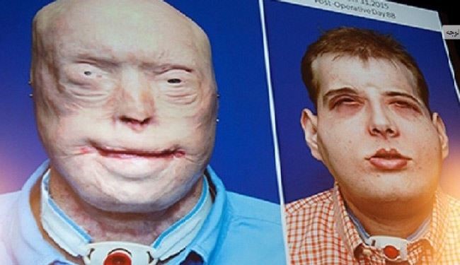تفاصيل أنجح عملية جراحية لزراعة الوجه