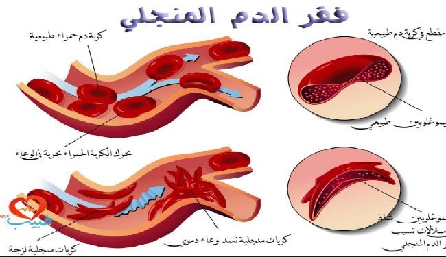 هذه العلامات الـ5...تشير إلى إصابتك بفقر الدّم