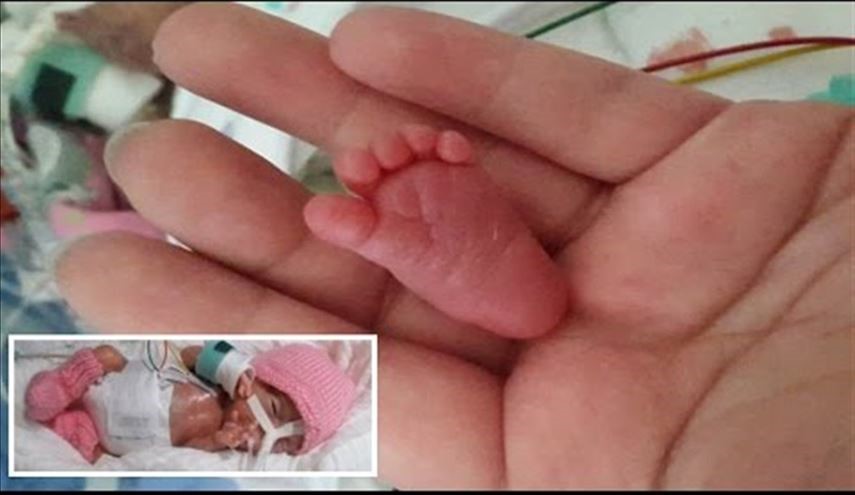 رجلها أصغر من اصبع إبهام اليد.. شاهد أصغر طفلة في العالم!