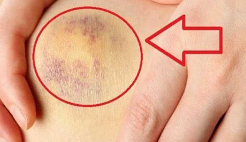 تستيقظ بكدمات غير مفسرة على جسمك؟ إليك السبب !
