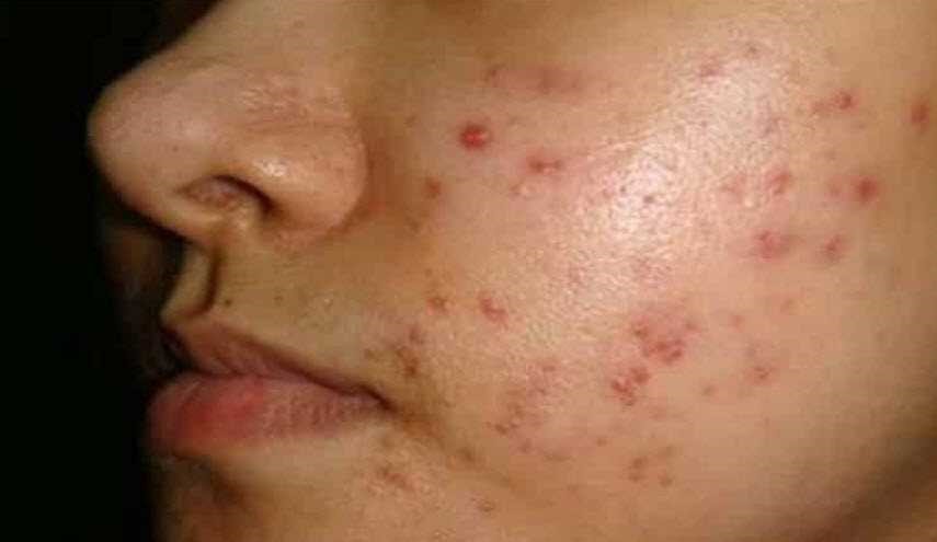 خطأ قاتل.. إحذر عصر البثور في 