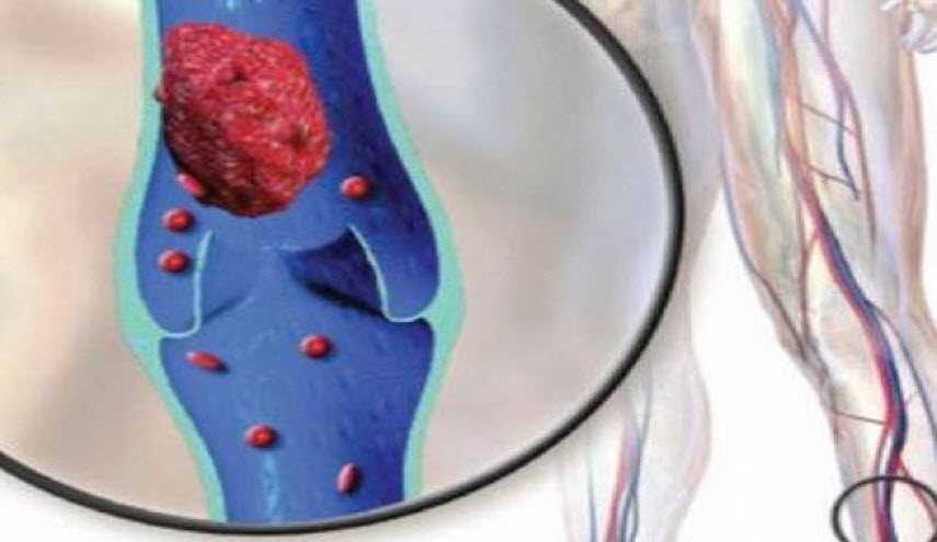 انتبهوا جيدا.. علامات تظهر على الجسم تنذر باحتمال حدوث جلطة