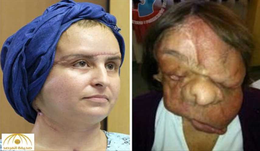بالصور؛ عملية زرع وجه لسيدة بولندية..