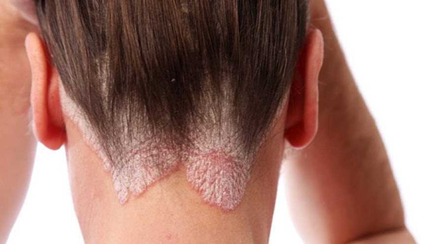 أكزيما الشعر.. تعرف على طرق تجنب حدوثها