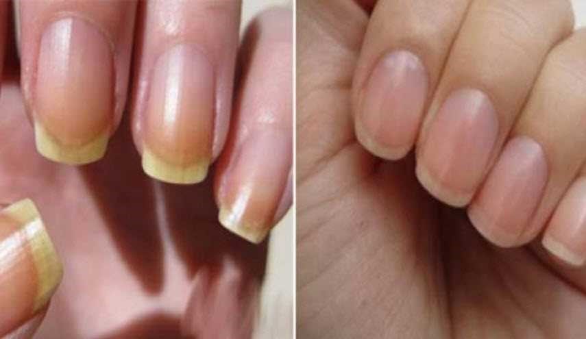 حيل طبيعية للتخلص من اصفرار الأظافر.. والنتيجة ستبهرك!