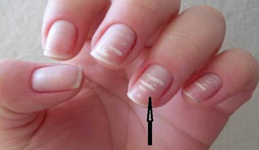 ماذا يقول شكل أظافرك عن صحتك؟