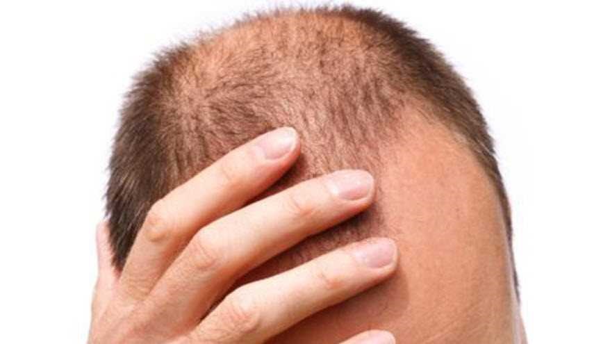 للنجاة من الصلع... 5 أشياء عليك فعلها عندما يبدأ شعرك بالتساقط