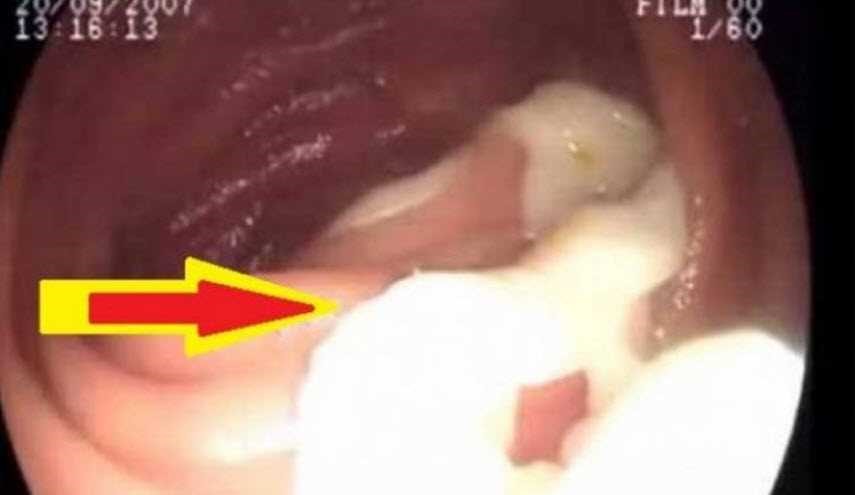 ظل يعاني من ألم المعدة لمدة عامين .. ما إكتشفه الأطباء أرعبهم!