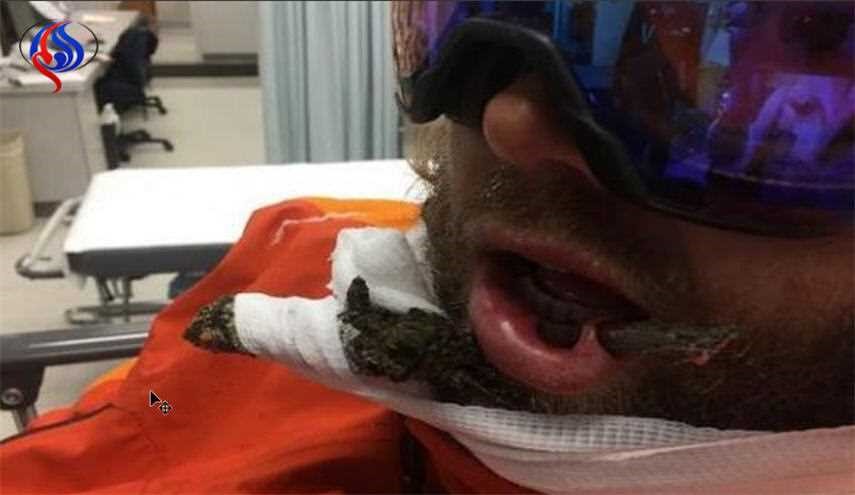 بالصور... لقطات صادمة لفرع شجرة يخترق شفاه رجل