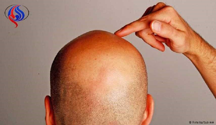 أسباب تعرض قصيري القامة للصلع المبكر