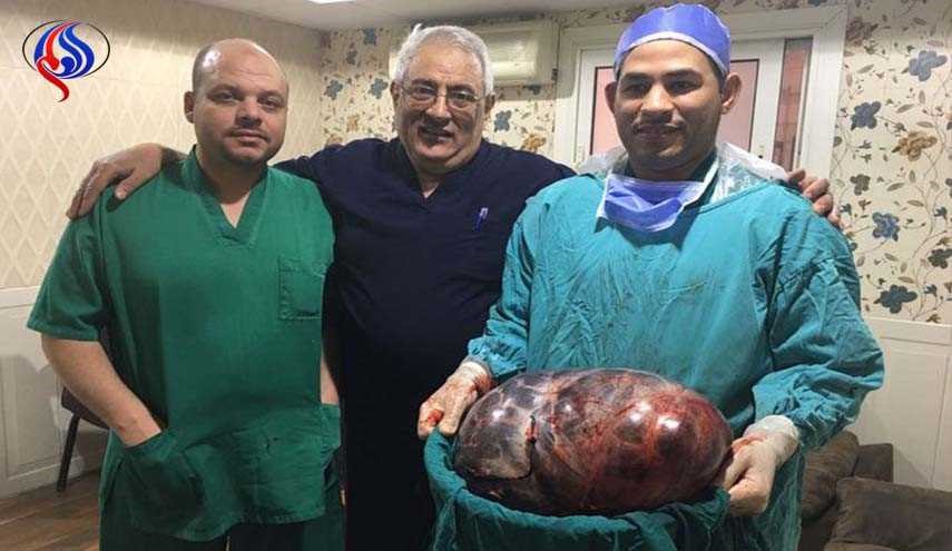 بالصور... استئصال ورم يزن 43 كيلو من بطن سيدة