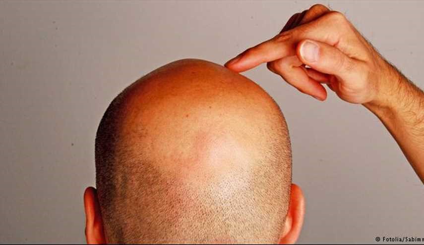 لماذا يتعرض قصيري القامة للصلع المبكر؟!