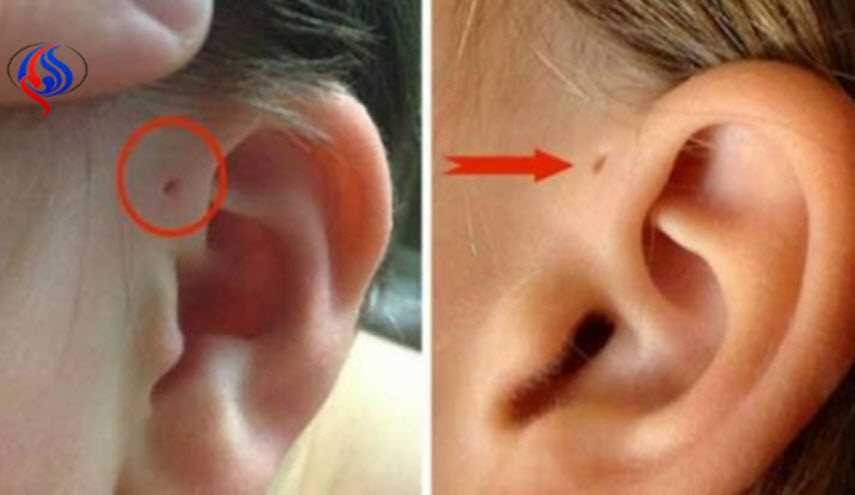 اذا كنت تمتلك هذه العلامة أعلى أذنك.. اقرأ هذا الخبر
